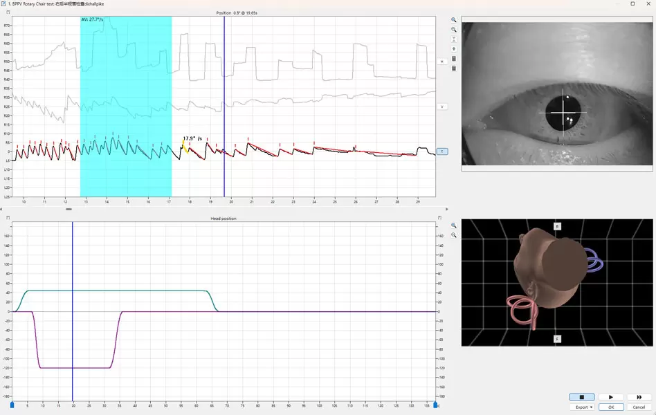 Rastreamento ocular 3D integrado com VertiGoggles&trade;